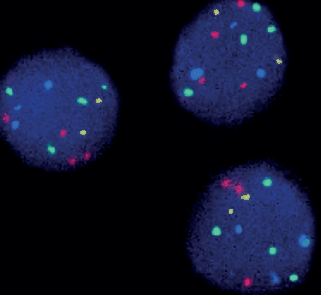 What Color Signifies Bladder Cancer / Bladder cancer - New quadruple color FISH probe Generon - Bladder cancer develops when the linings of the bladder start to grow without any.